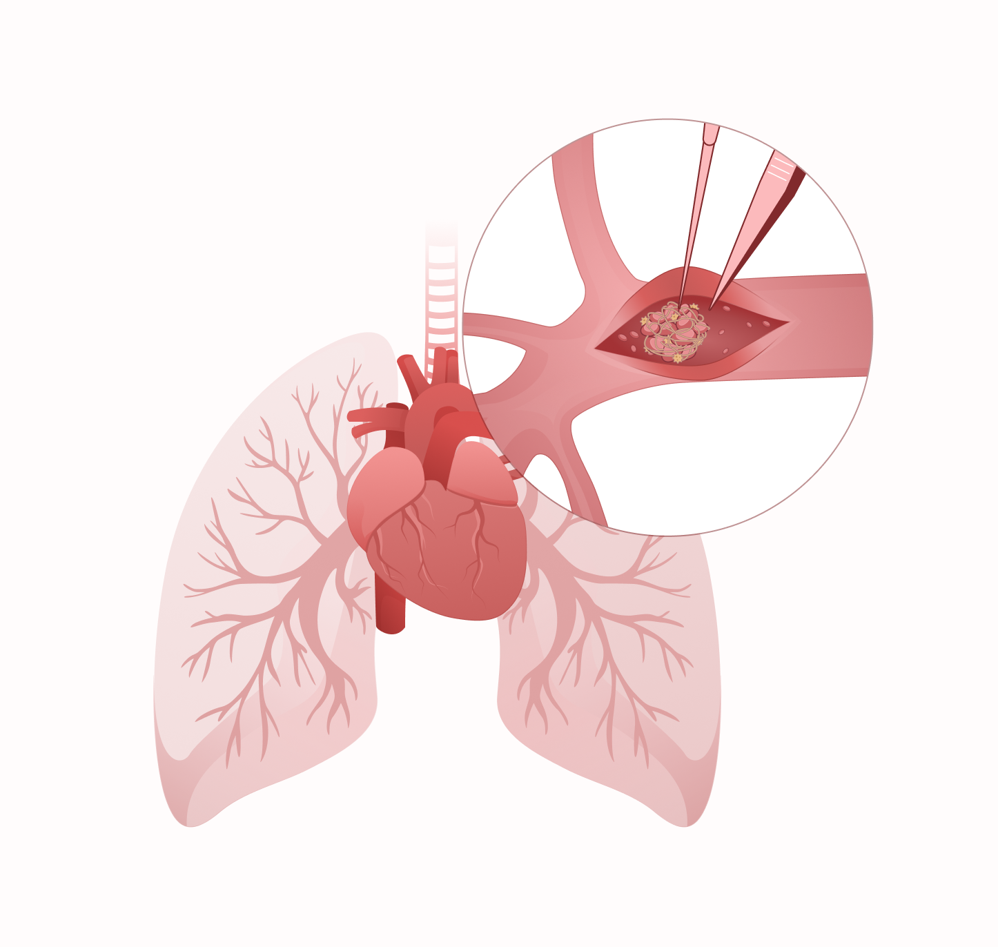 Chronisch-thromboembolische pulmonale Hypertonie I MSD Gesundheit Schweiz